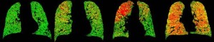COPD